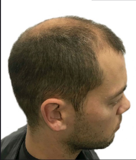 Before hair transplant at Replace Clinic