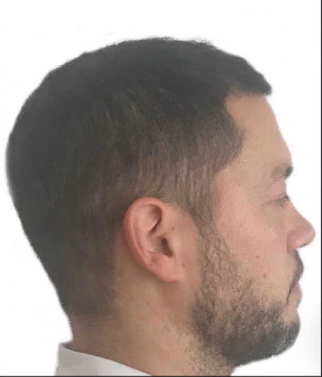 After hair transplant at Replace Clinic, twelve months result